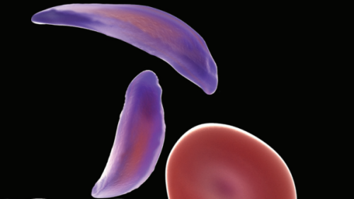 Sickle Cell Anemia Is On The Rise Worldwide
