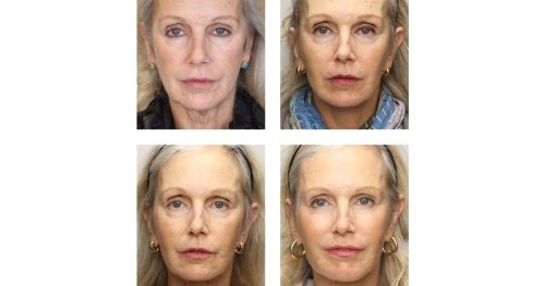 Can You Get a Facelift in 1,000 Tiny Steps?