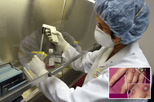 What is monkeypox virus maryland infection is second in us of 2021 