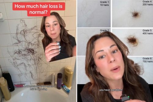 I’m a dermatologist — here’s when you should be concerned about hair loss