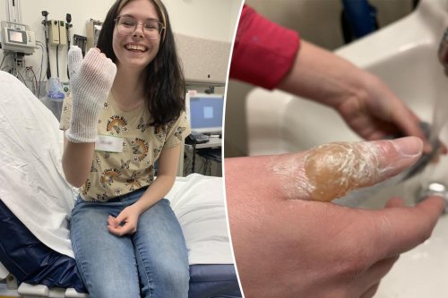 Teen traumatized after ‘sugar waxing’ trend leaves her with burns, scarring
