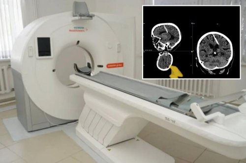 80-year-old Russian woman found living with needle in brain after parents’ failed World War II infanticide