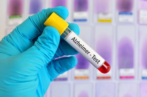 Blood test could detect Alzheimer’s disease early, study finds