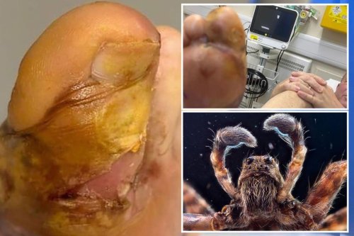 Wolf spider lays eggs in man’s toe, baby hatches inside: ‘Eating its way out’