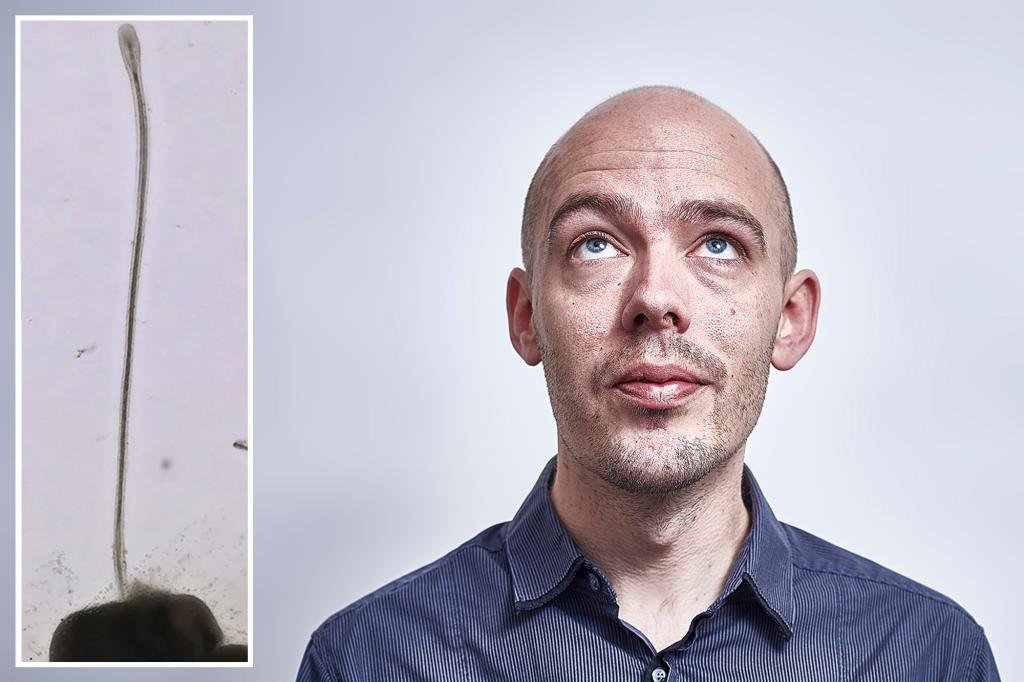 A cure for hair loss? Scientists grow hair follicles in new