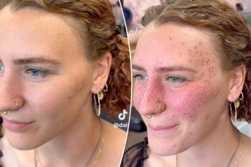 I got freckle tattoos — people say they will ‘age like a tramp stamp