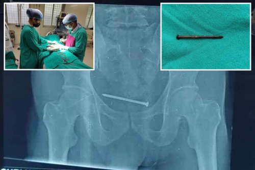 Man had 4-inch nail lodged in bladder — for an entire year