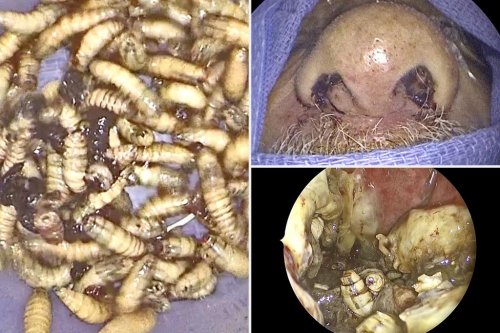 Florida man has 150 live bugs removed from his nose — and he didn’t even know they were there