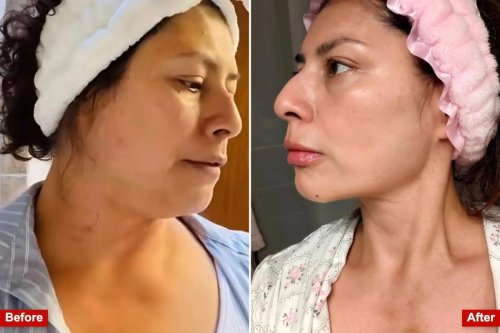 Meet the women performing at-home liposuction on themselves with shady $95 kits to shed weight