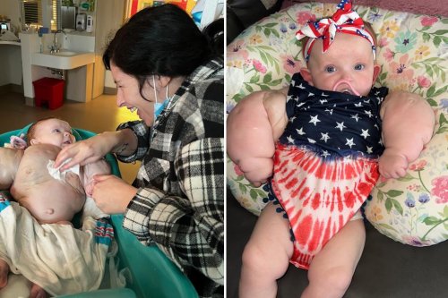 ‘Baby hulk’ with rare condition defeats the odds: ‘It’s a very magical story’