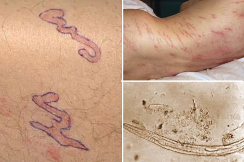 I discovered worms wiggling under my skin — I could have died