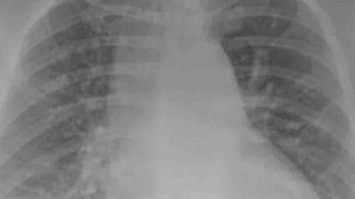 Covid-19 coronavirus: X-ray shows difference vaccine can make to lung health - NZ Herald