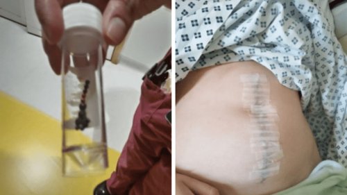 Teenager in hospital after swallowing 15 magnets for TikTok challenge - NZ Herald
