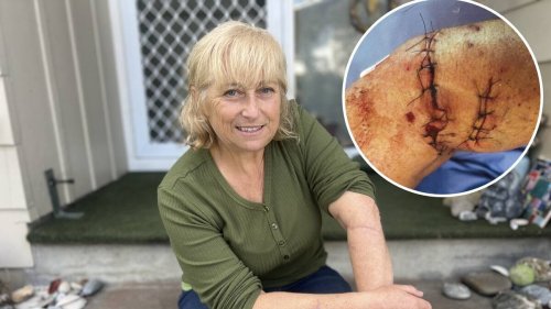Rotorua woman badly mauled by dogs lives with legacy of fear