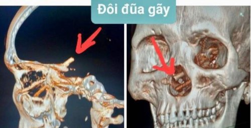 Man Suffering from Headaches for 5 Months Discovers Chopsticks Stuck in His Skull