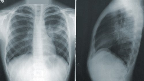 COVID-19: Röntgenbilder zeigen "schockierende Unterschiede" in den Lungen von Geimpften und Ungeimpften
