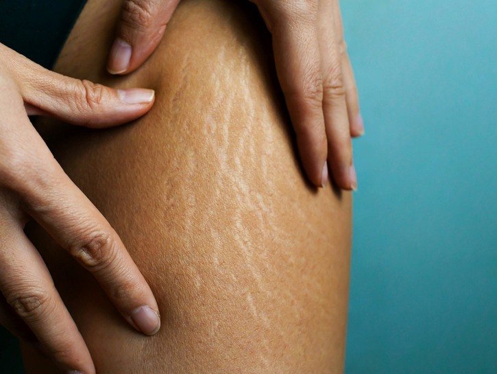 12 of the Best Products to Get Rid of Stretch Marks
