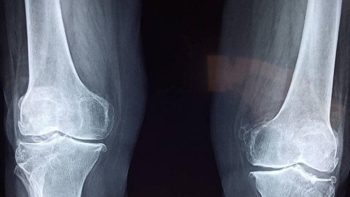 Elle vivait avec une aiguille « oubliée » dans la jambe : « Je ne m’arrête jamais pour un rhume »