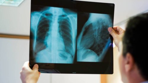 De meilleures nouvelles pour les malades du cancer du poumon