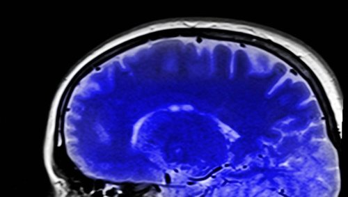Une nouvelle étude suggère que le Covid-19 endommagerait le cerveau de malades, même asymptomatiques