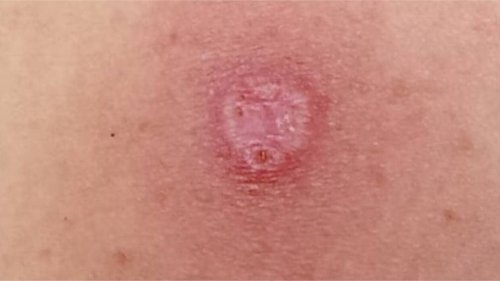 Ce que l’on sait de l’Alaskapox, mystérieux virus qui vient de faire son premier mort
