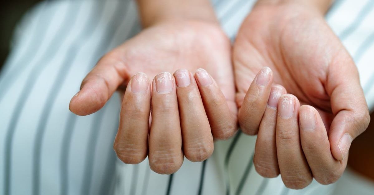 Got Ridges in Your Fingernails? Here's Exactly What That Means, and What to Do About It