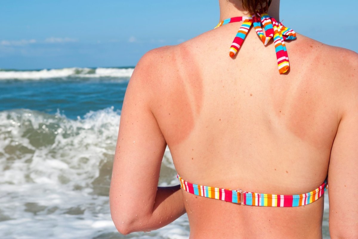 Here's How to Prevent Peeling after a Sunburn