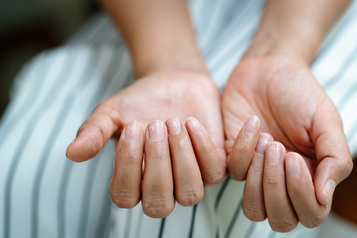 What Causes Ridges on Your Fingernails?