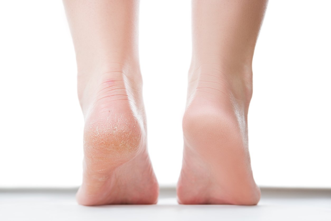 Are Your Feet Peeling? Here Are 7 Possible Reasons Why It's Happening, According to Dermatologists—and What to Do