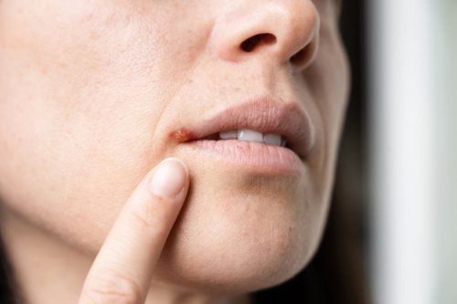 The #1 Thing Most People Don't Know Can Cause a Cold Sore, According to Dermatologists