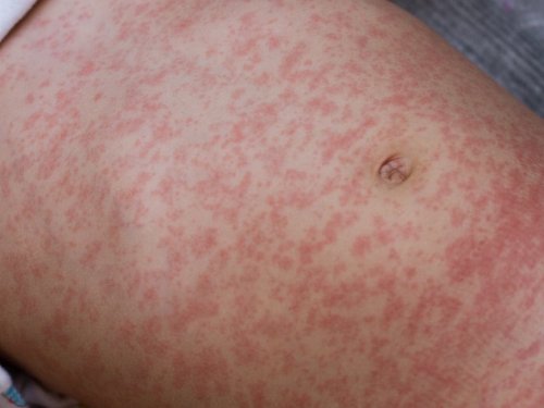 Measles Reported In NY, 16 Other States In Global Uptick: CDC Advisory