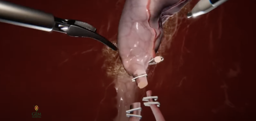 Watch a surgeon wearing Apple Vision Pro remove a gallbladder (video) | Philip Elmer‑DeWitt