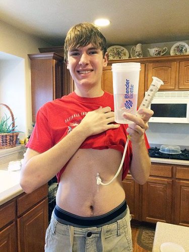 Utah Teen Discovers He's Allergic to Food: 'I Remember What it Tastes Like, That Will Have to Be Enough'