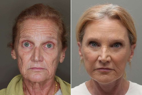 Woman, 67, 'Couldn't Close' Her Eye After Botched Facelift. One 4-Hour Surgery Later Her Results Are Shocking (Exclusive)