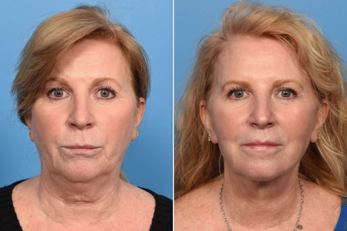 Her Daughter's Wedding Inspired Her to Get a Facelift at 60. See the Dramatic Mother-of-the-Bride Makeover (Exclusive)
