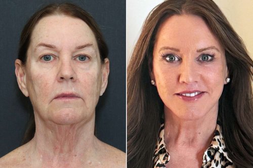 Woman, 66, Lost 110 Pounds and Got a Dramatic Facelift So Shocking, the Internet Thought It Was Fake (Exclusive)