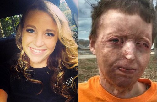 Georgia Mom, 29, Disfigured in Campfire Accident: 'My Burns Don't Define Who I Am'