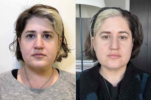 Bride Lets ChatGPT Decide What Cosmetic Procedures She Gets Done Before Wedding: See Her Before and After (Exclusive)