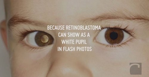 Did You Know You Can Easily Check Children for Eye Cancer Using Flash Photography?