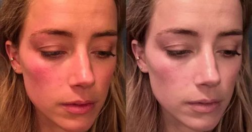 Amber Heard Photoshopped Injury Photos: Johnny Depp's Lawyer