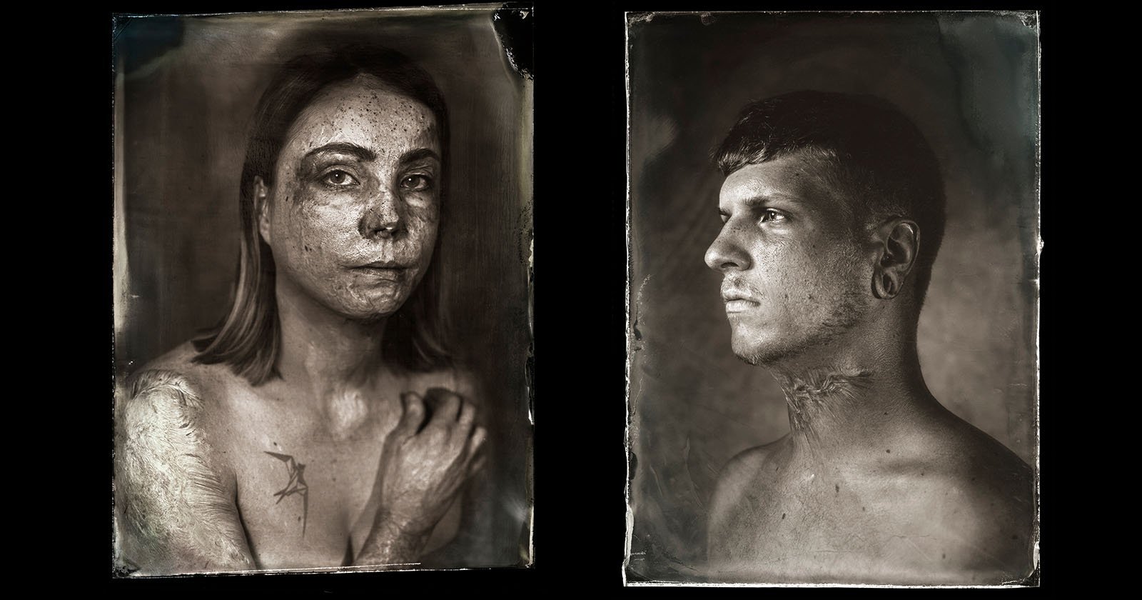 Wet Plate Collodion Portraits of Burn Victims