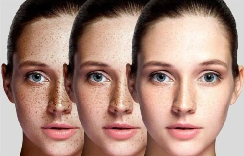 How to Treat Skin Pigmentation with Naturally Occurring Ingredients