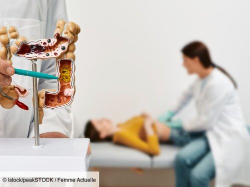 L'aliment numéro 1 à limiter pour réduire votre risque de cancer colorectal, selon un oncologue