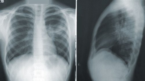 Arzt enthüllt schockierende Röntgenbilder, die Lungen von Geimpften und Ungeimpften zeigen