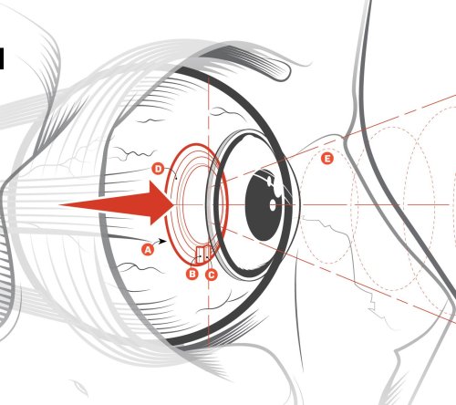Contact Lens Sees Eye Disease Before It Strikes