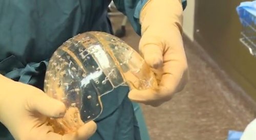 Woman Has Her Skull Replaced With A 3-D-Printed Plastic One