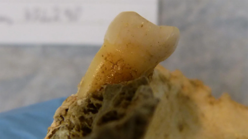 Rare traces of tooth decay and gum disease found in Bronze Age teeth