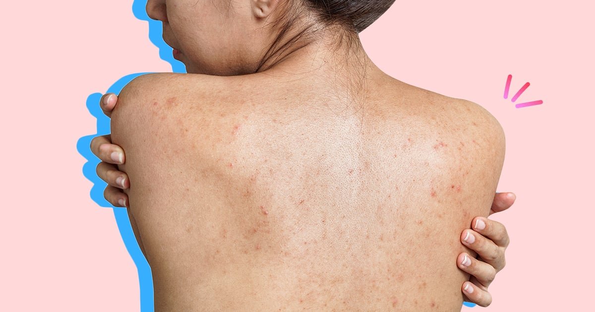 How to Get Rid of Acne Scars and Marks, According to Dermatologists
