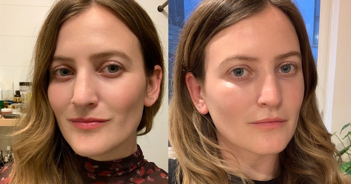 I Got Undereye Fillers, and the Results Are Game-Changing