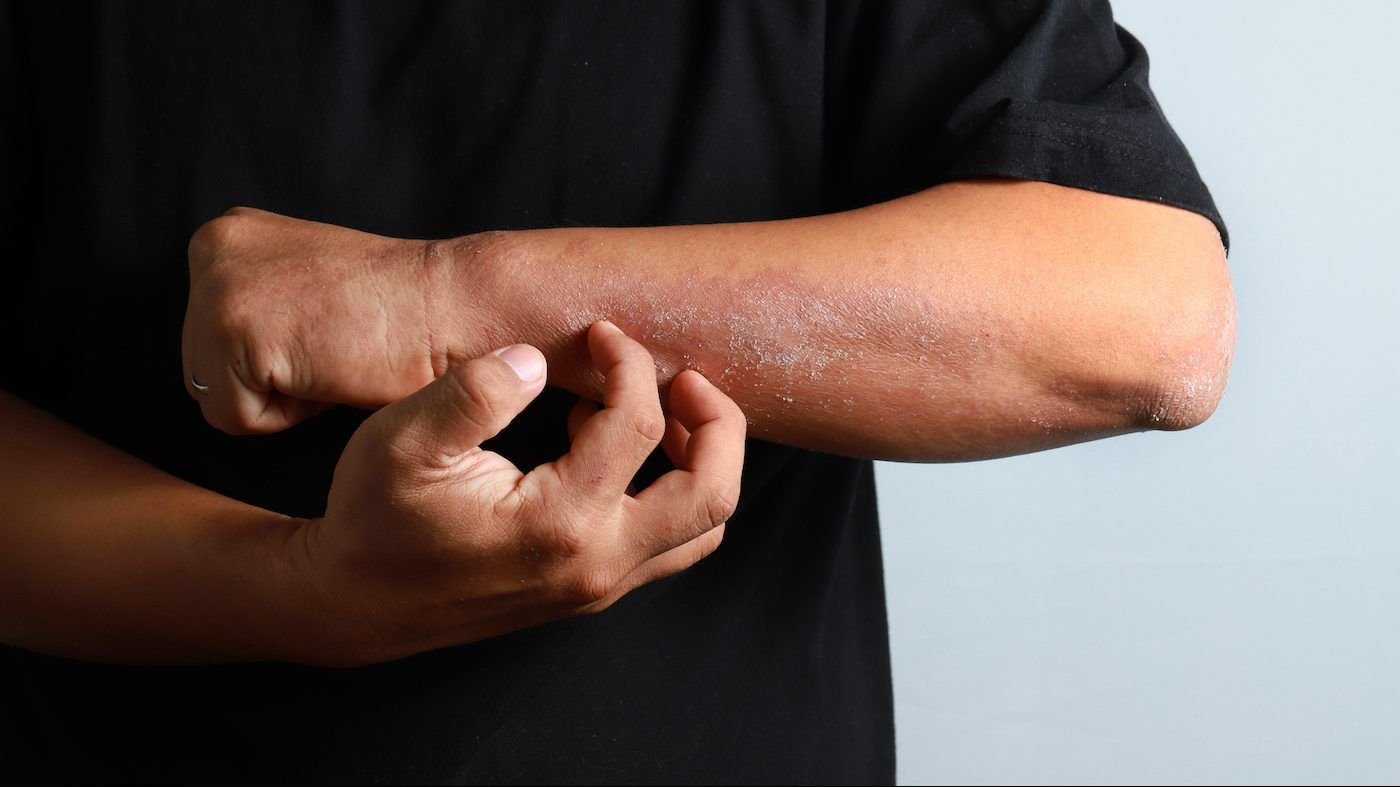 Know The Signs: Eczema